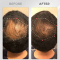 Before and after derma roller for hair growth UAE thinning hair and crown results