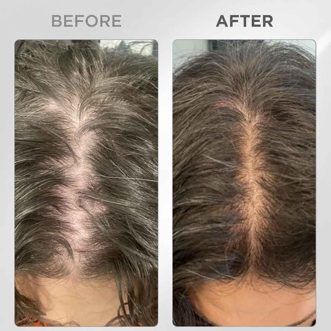 Scalp massager with hair growth serum enhanced absorption for UAE hair fall treatment